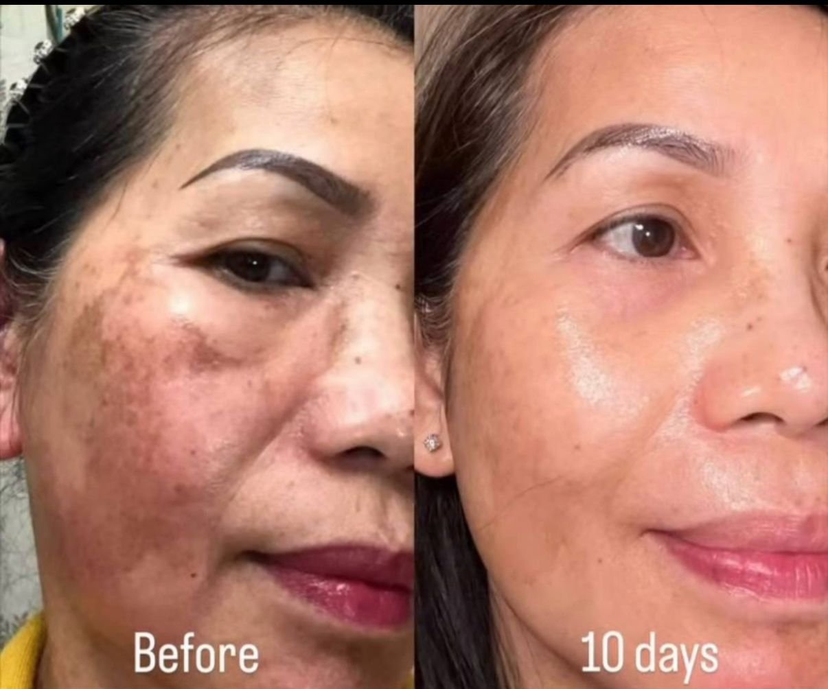 Before and after RIMAN — hyperpigmentation