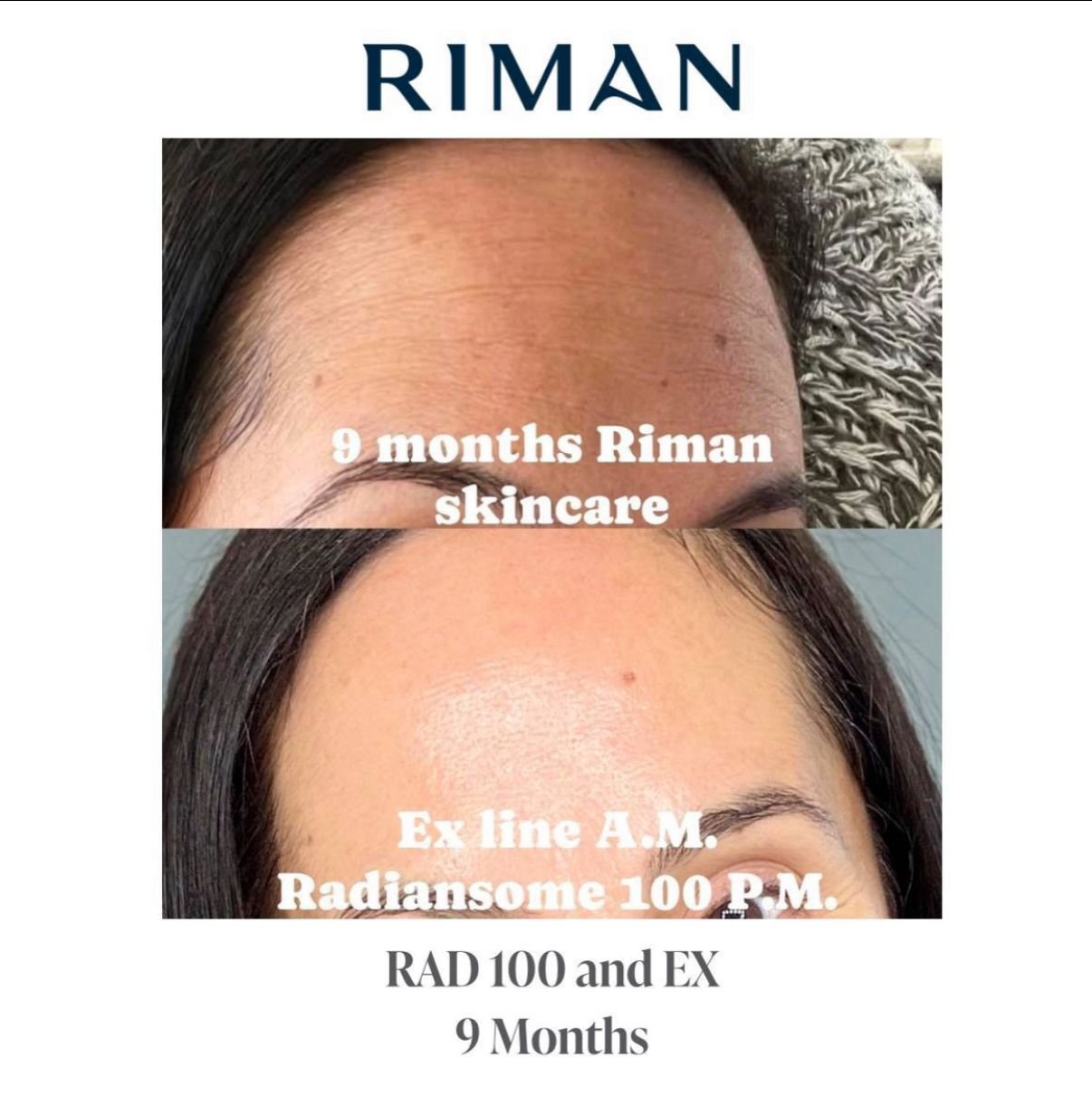 Before and after RIMAN — Radiansome 100, 9 months