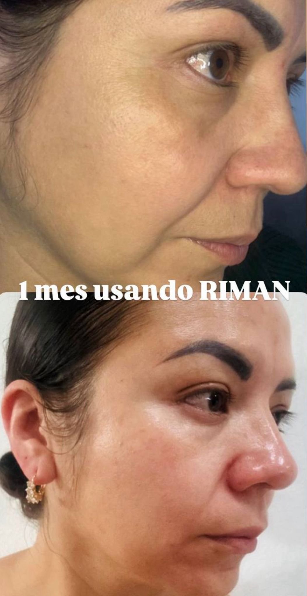 Before and after RIMAN — firmness and glow