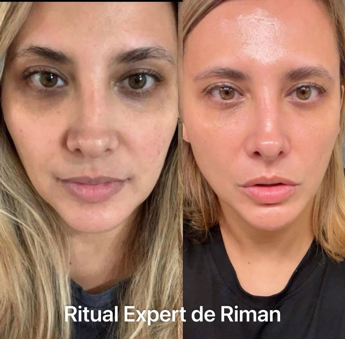 Before and after RIMAN — brightness and under-eye